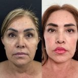 Facelift before and after results at Marroquín & Sandoval Plastic Surgery Clinic, facial rejuvenation