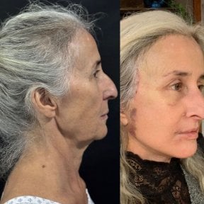 Facelift before and after results at Marroquín & Sandoval Plastic Surgery Clinic, facial rejuvenation