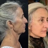 Facelift before and after results at Marroquín & Sandoval Plastic Surgery Clinic, facial rejuvenation