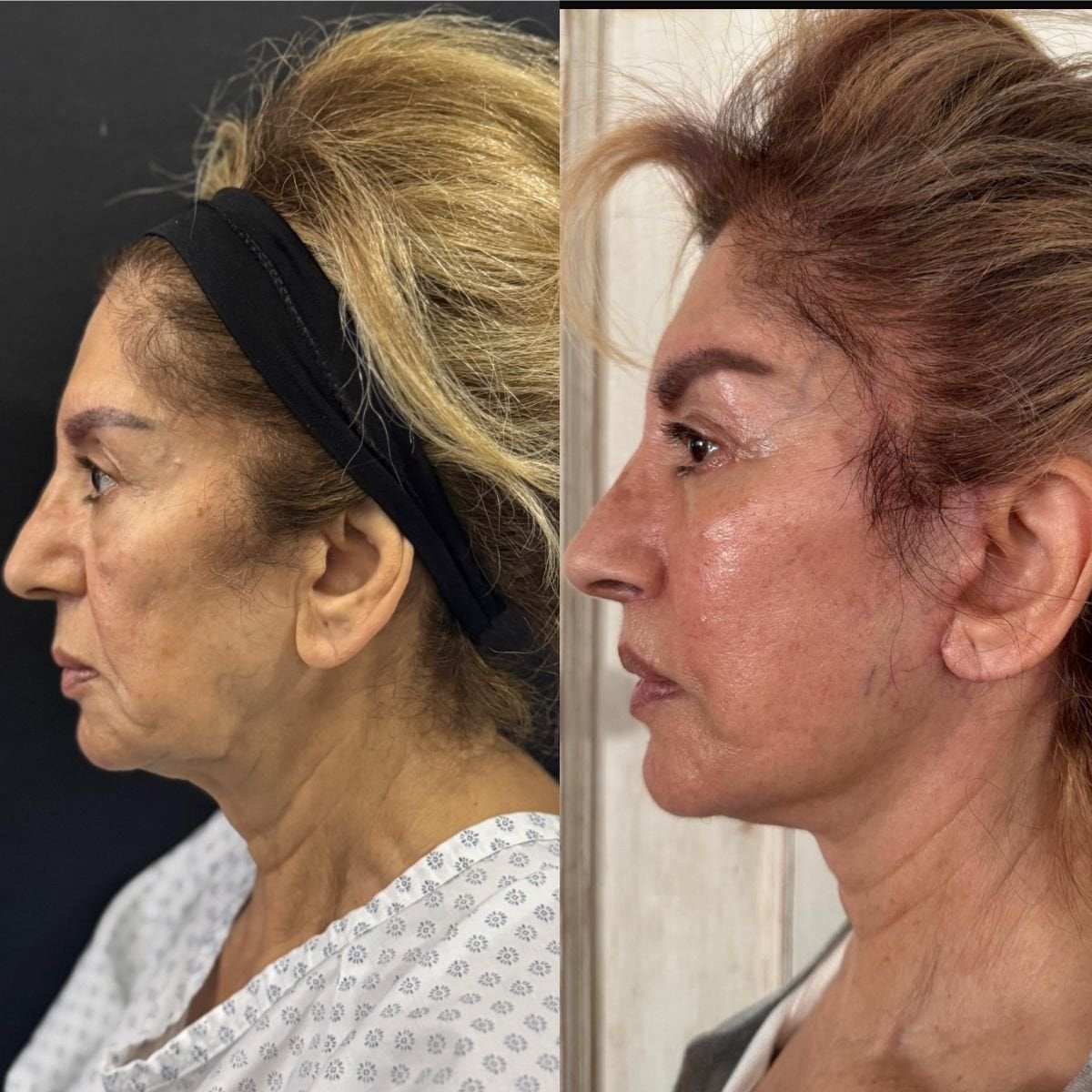 Facelift results at Marroquín & Sandoval Plastic Surgery Clinic