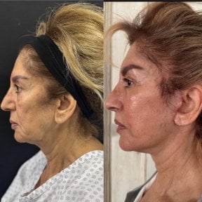 Facelift before and after results at Marroquín & Sandoval Plastic Surgery Clinic, facial rejuvenation