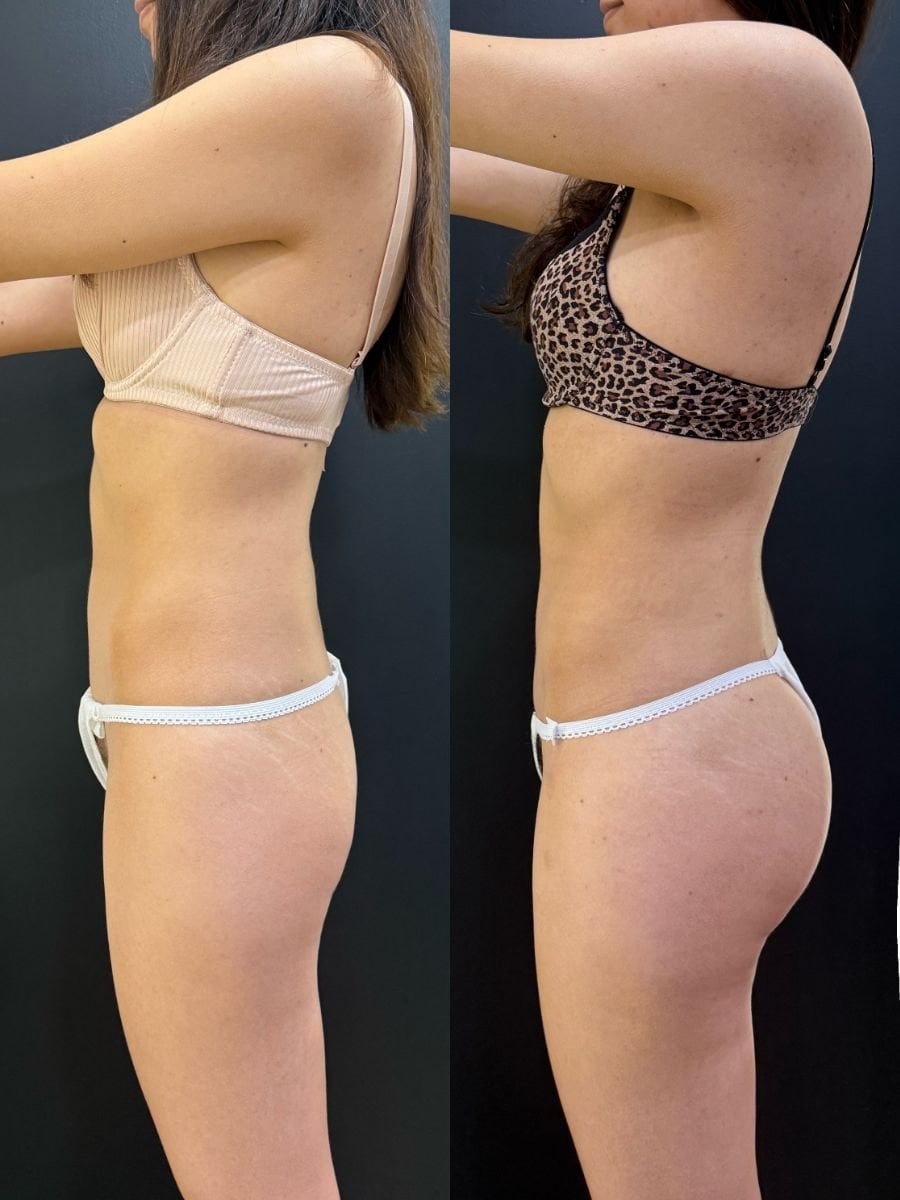 Before and after liposuction results at Dr. Alexandro Aguilera - Plastic Surgery, body contouring