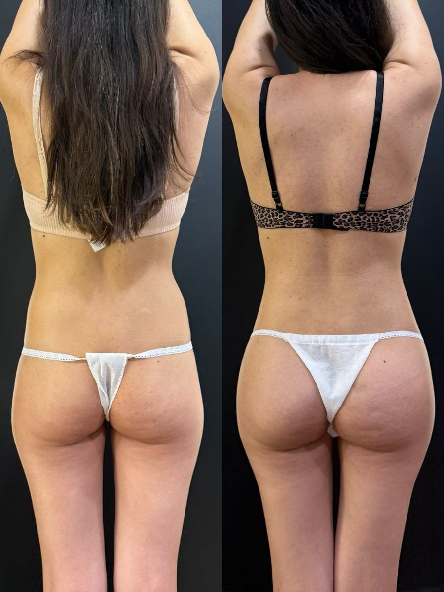 Before and after liposuction results at Dr. Alexandro Aguilera - Plastic Surgery, body contouring