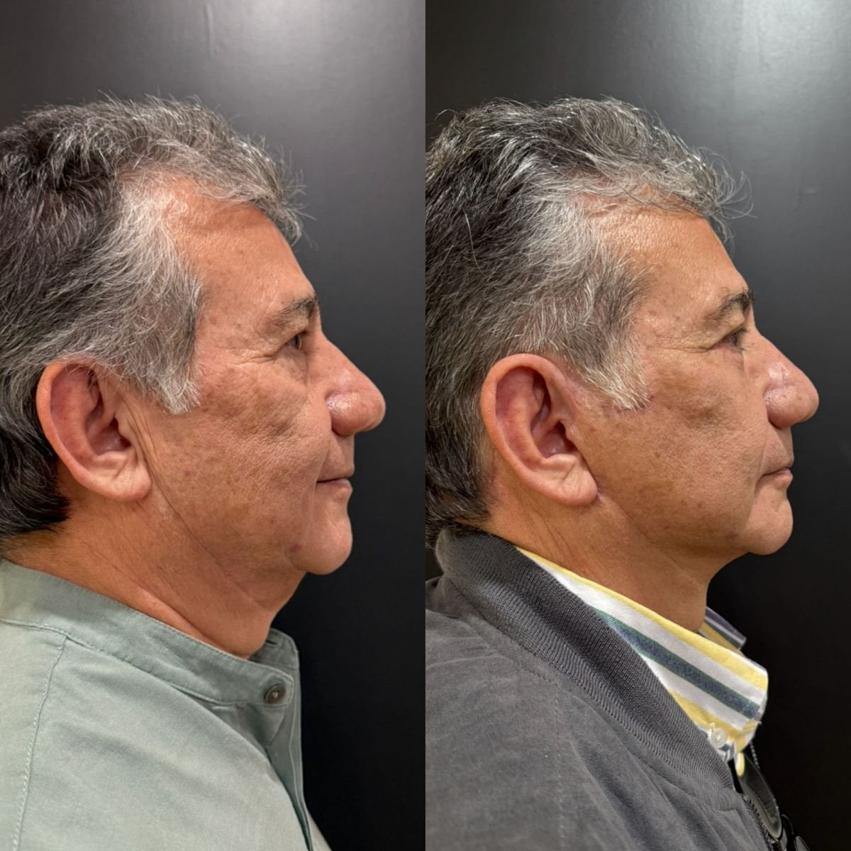 Before and after mini facelift results at Dr. Alexandro Aguilera - Plastic Surgery, facial rejuvenation