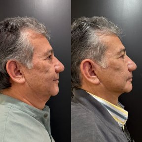 Результаты мини-подтяжки лица до и после в Dr. Alexandro Aguilera - Plastic Surgery, омоложение