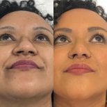 Resultados de rinoplastia antes y después en Odontoliuzzi Dentistry and Health, remodelación nasal