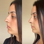 Resultados de rinoplastia antes y después en Odontoliuzzi Dentistry and Health, remodelación nasal