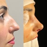 Resultados de rinoplastia antes y después en Odontoliuzzi Dentistry and Health, remodelación nasal