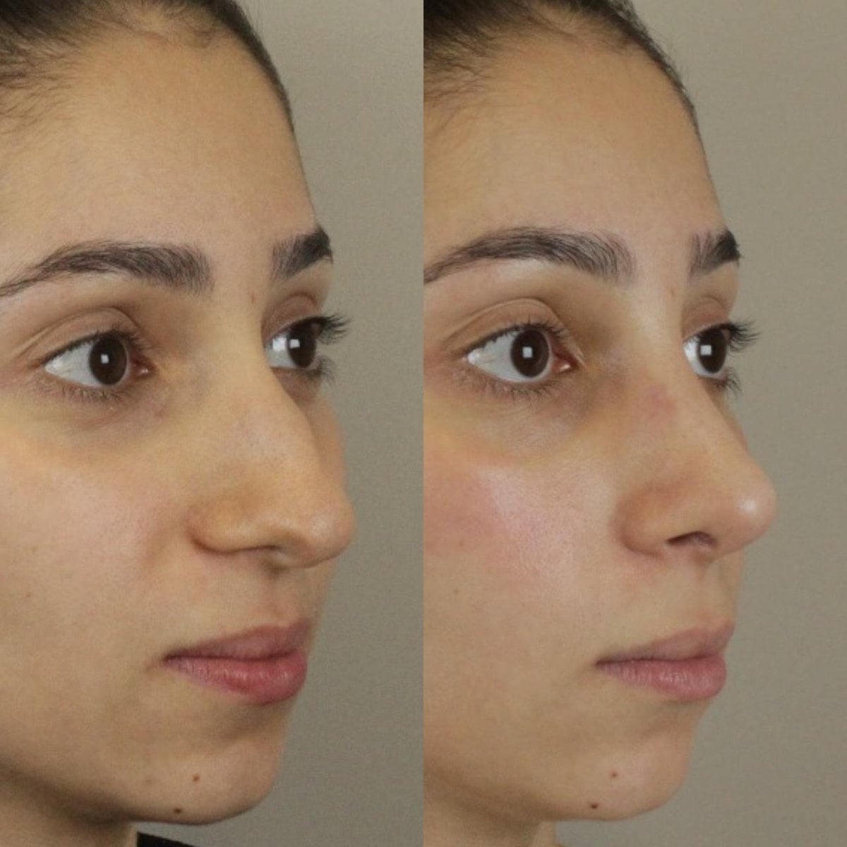 Resultados de rinoplastia antes y después en Odontoliuzzi Dentistry and Health, remodelación nasal
