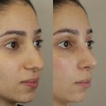 Resultados de rinoplastia antes y después en Odontoliuzzi Dentistry and Health, remodelación nasal