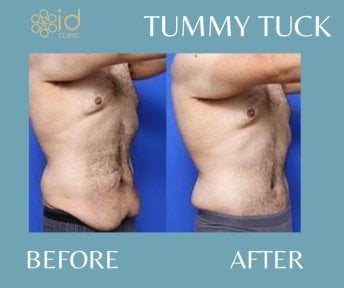 Before and after tummy tuck results at ID Clinic Bangkok, visible abdominal contour improvement