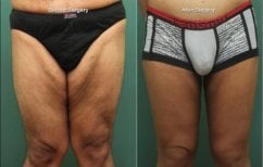 Before and after full body lift results at ID Clinic Bangkok, improved thigh contour visible