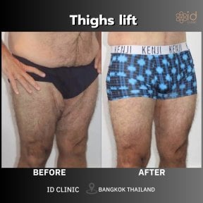 Before and after thigh lift results at ID Clinic Bangkok, improved thigh contour and firmness