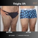 Before and after thigh lift results at ID Clinic Bangkok, improved thigh contour and firmness