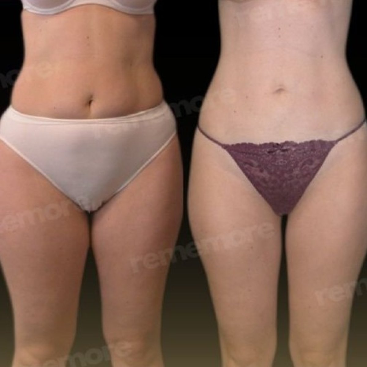 Resultados de liposucción de muslos antes y después en Memorial Göztepe Hospital, muslos más delgados