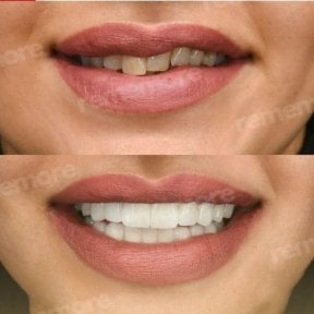 Vorher-nachher-Veneers bei Memorial Bahçelievler Hospital – Ergebnis des Smile-Makeovers