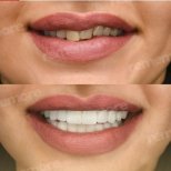 Vorher-nachher-Veneers bei Memorial Bahçelievler Hospital – Ergebnis des Smile-Makeovers