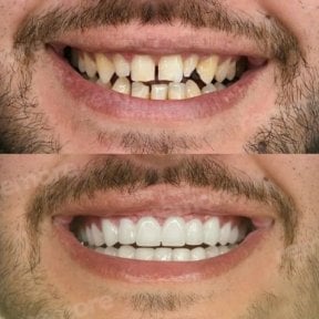 Vorher-nachher-Veneers bei Memorial Bahçelievler Hospital – Ergebnis Smile Makeover