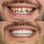 Vorher-nachher-Veneers bei Memorial Bahçelievler Hospital – Ergebnis Smile Makeover