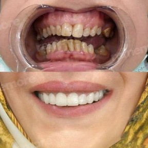 Vorher-nachher Veneers bei Memorial Bahçelievler Hospital – Ergebnis Smile Makeover