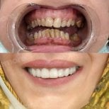 Vorher-nachher Veneers bei Memorial Bahçelievler Hospital – Ergebnis Smile Makeover