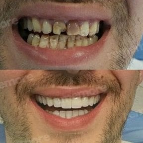 Vorher-nachher-Veneers bei Memorial Bahçelievler Hospital – Ergebnis Smile-Makeover