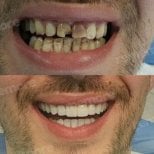 Vorher-nachher-Veneers bei Memorial Bahçelievler Hospital – Ergebnis Smile-Makeover