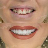 Vorher-nachher-Veneers bei Memorial Bahçelievler Hospital, Ergebnis Smile-Makeover