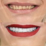 Vorher-nachher-Veneers bei Memorial Bahçelievler Hospital – Ergebnis der Lächelumwandlung