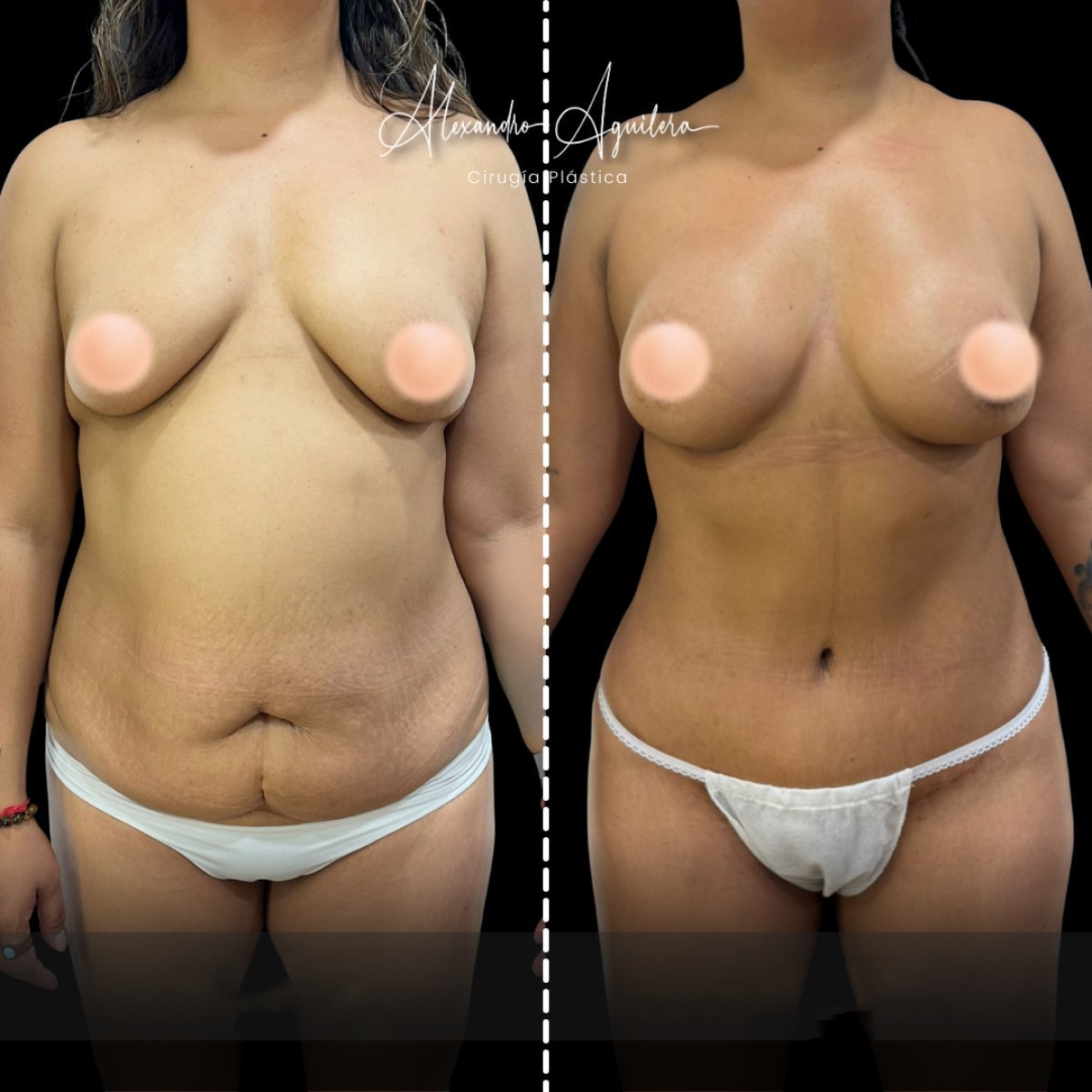 Before and after breast lift results at Dr. Alexandro Aguilera - Plastic Surgery, improved contour