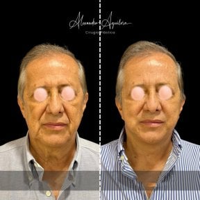Результаты мини-подтяжки лица до и после в клинике Dr. Alexandro Aguilera - омоложение лица