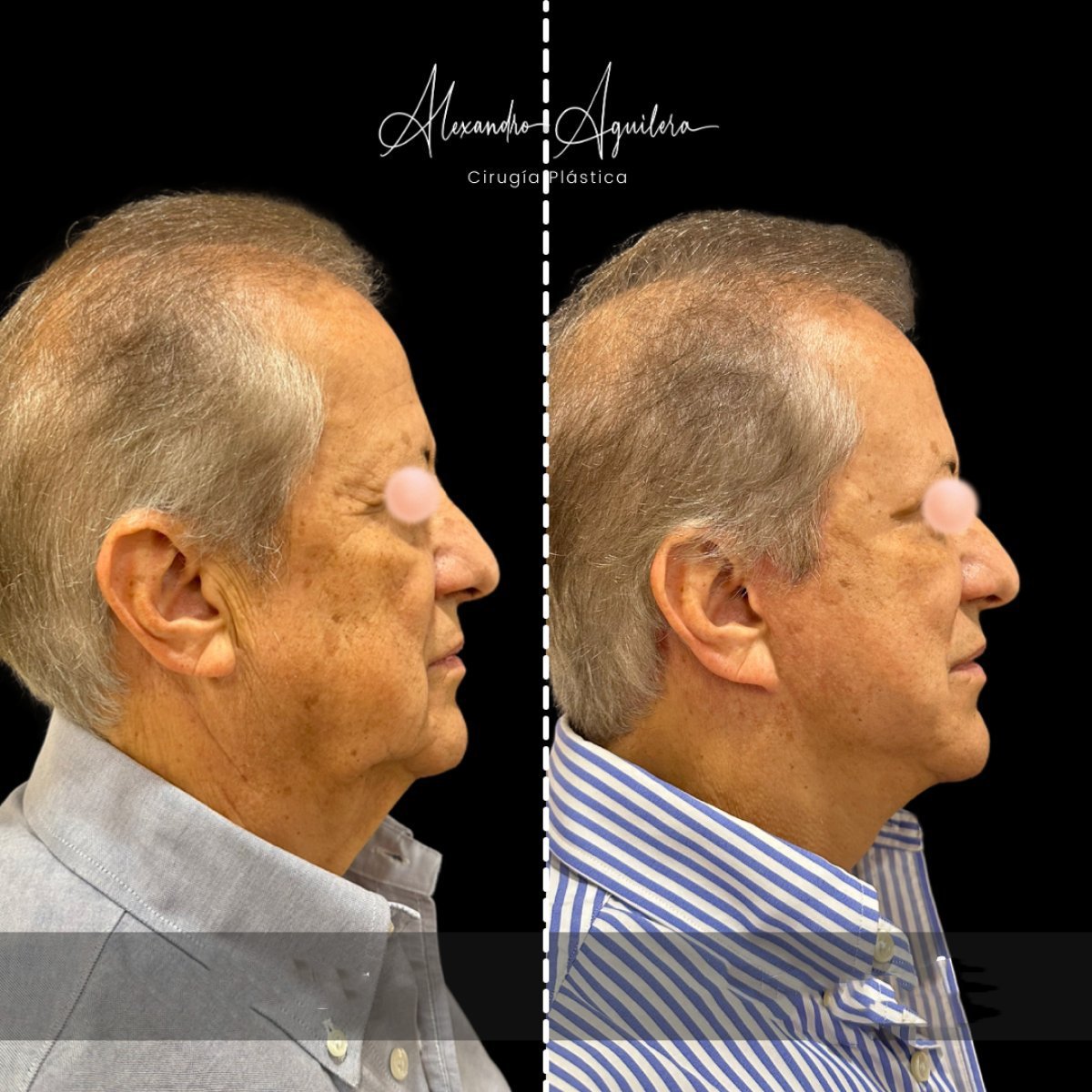 Before and after mini facelift results at Dr. Alexandro Aguilera - Plastic Surgery, facial rejuvenation