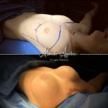 Resultados antes y después de aumento de senos en Dr. Alexandro Aguilera - Cirugía Plástica