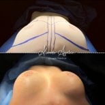 Resultados antes y después de aumento de senos en Dr. Alexandro Aguilera - Cirugía Plástica