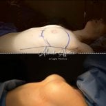 Resultados de aumento de senos antes y después en Dr. Alexandro Aguilera - Cirugía Plástica