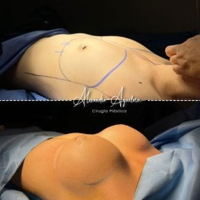 Resultados antes y después de aumento de senos en Dr. Alexandro Aguilera - Cirugía Plástica