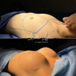 Resultados antes y después de aumento de senos en Dr. Alexandro Aguilera - Cirugía Plástica