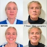 Before and after facelift results at ID Clinic Bangkok, visible facial rejuvenation after 7 days