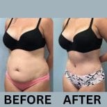 Before and after mommy makeover results at ID Clinic Bangkok, visible body contour improvement