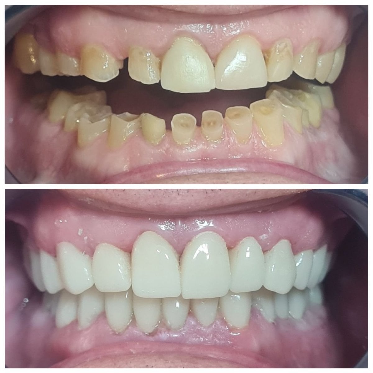 Before and after dental veneers at SoftDentalCare Clinic – smile makeover with natural results