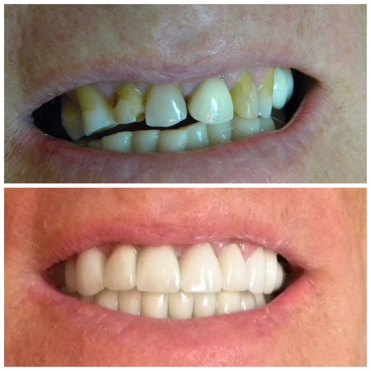 Before and after veneers at SoftDentalCare Clinic – smile makeover with natural-looking results
