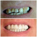 Vorher-nachher-Veneers bei SoftDentalCare Clinic – natürliches Lächeln-Ergebnis