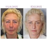 Before and after neck lift results at Db'est Clinic, visible facial rejuvenation and smoother skin
