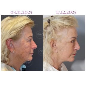Before and after neck lift results at Db'est Clinic – visible skin tightening and rejuvenation