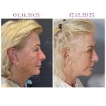 Before and after neck lift results at Db'est Clinic – visible skin tightening and rejuvenation
