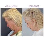 Before and after neck lift results at Db'est Clinic – visible neck tightening and rejuvenation