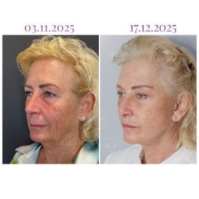 Before and after neck lift results at Db'est Clinic, visible skin tightening and rejuvenation