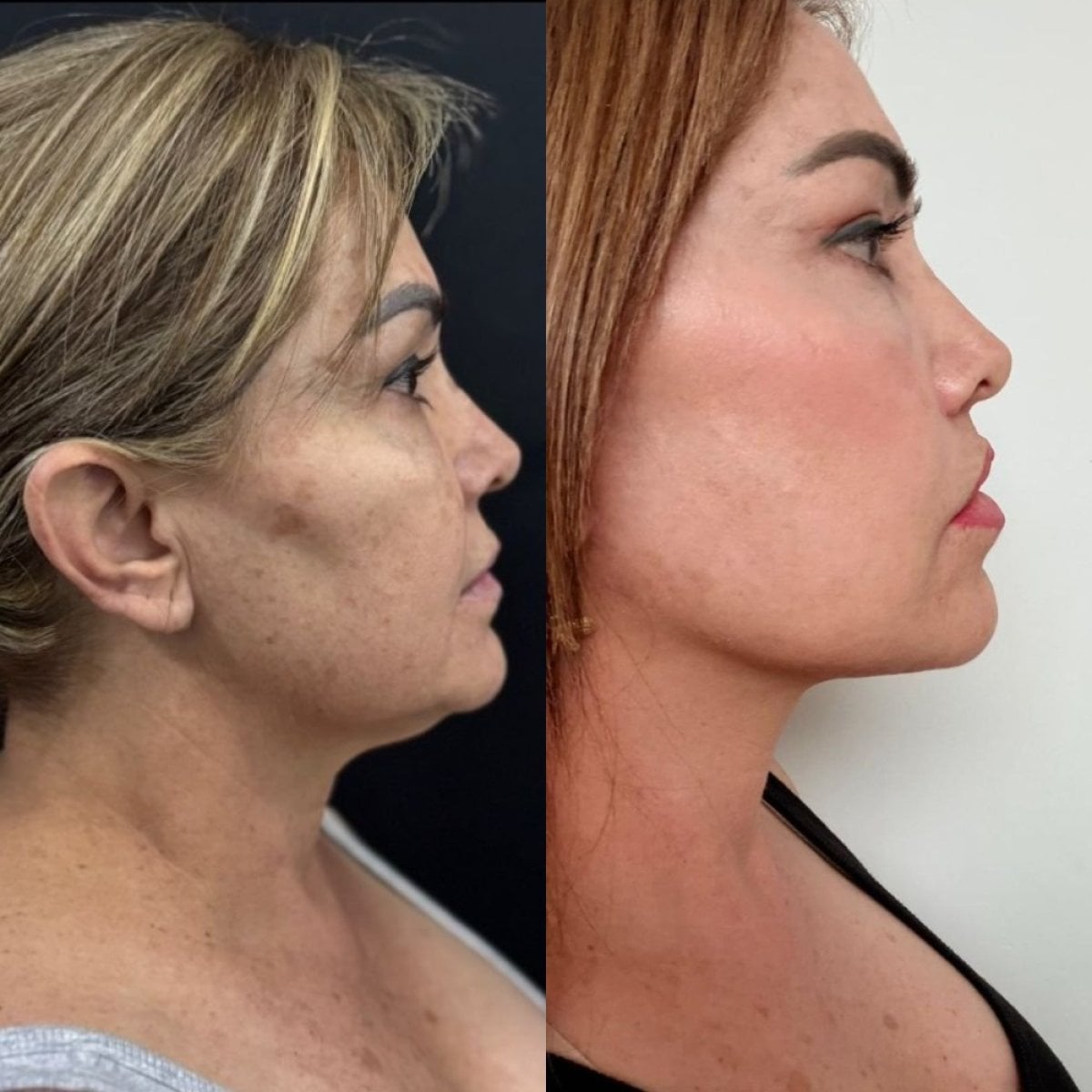 Facelift results at Marroquín & Sandoval Plastic Surgery Clinic