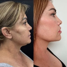 Facelift before and after results at Marroquín & Sandoval Plastic Surgery Clinic, facial rejuvenation
