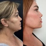 Facelift before and after results at Marroquín & Sandoval Plastic Surgery Clinic, facial rejuvenation